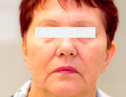 Лазерное омоложение лица до после