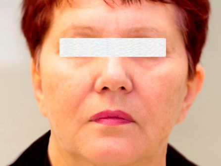 Лазерное омоложение лица до после