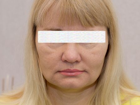 Лазерное омоложение лица до после