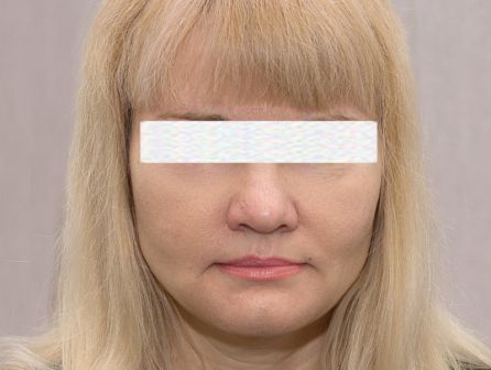 Лазерное омоложение лица до после