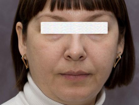 Лазерное омоложение лица до после