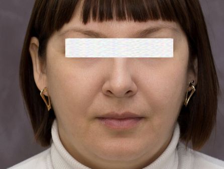 Лазерное омоложение лица до после