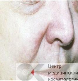 Лазерное удаление сосудов на ногах до после