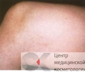 Лазерное удаление сосудов на ногах до после