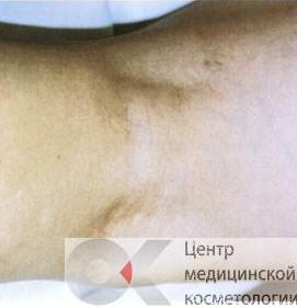 Лазерное удаление сосудов на ногах до после