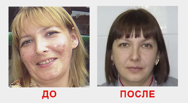 до и после процедуры лазерного омоложения лица