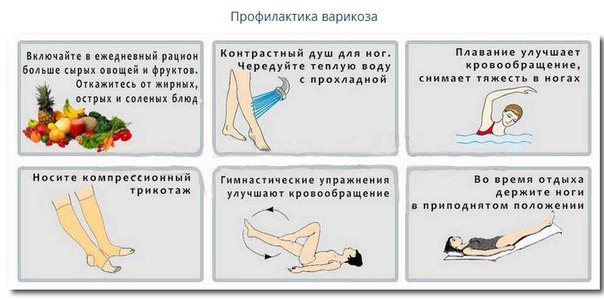 Профилактика помогающая сделать удаление сосудов на ногах