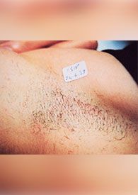Лазерная эпиляция александритовым лазером до после