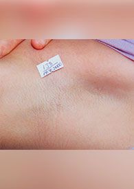 Лазерная эпиляция александритовым лазером до после