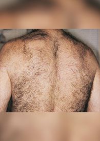 Лазерная эпиляция александритовым лазером до после