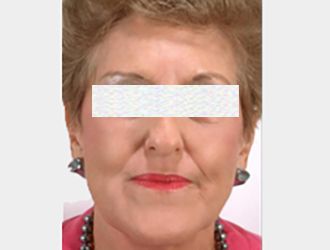 3D-мезонити до после