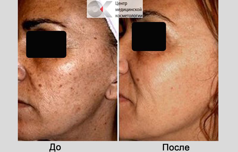 избавиться от пигментных пятен до после