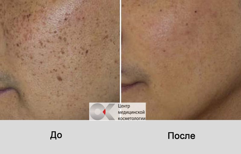 избавиться от пигментных пятен до после