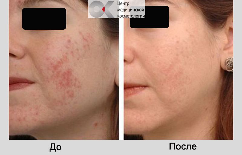 избавиться от пигментных пятен до после
