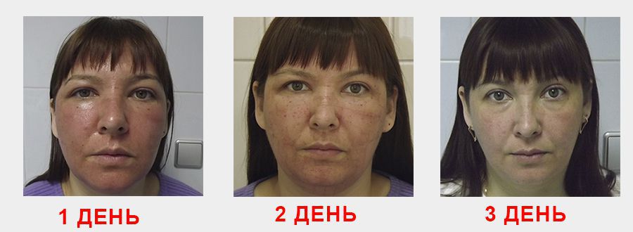процедура лазерного омоложения лица