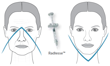 биоармирование лица филлером Radiesse