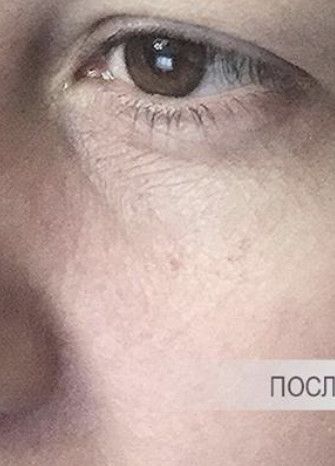 SMAS-лифтинг до после